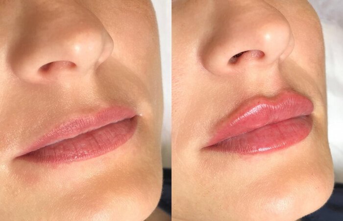 Lip Plumper - Ross Berry